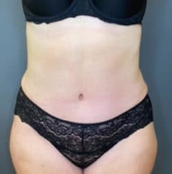 Tummy Tuck