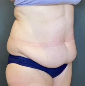 Tummy Tuck