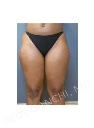 Liposuction