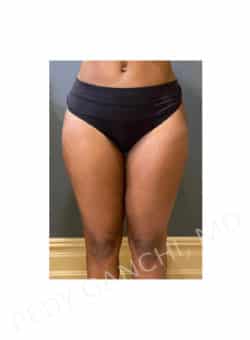 Liposuction