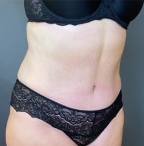 Tummy Tuck