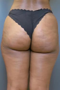 Liposuction