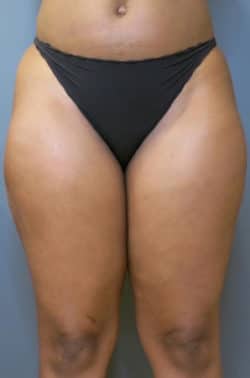 Liposuction