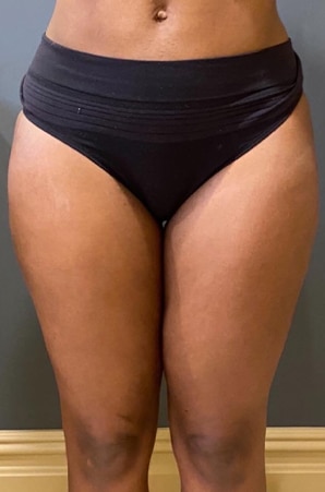 Liposuction