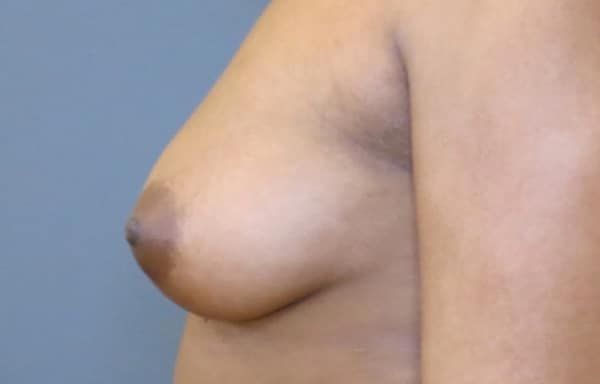 Breast Fat Grafting