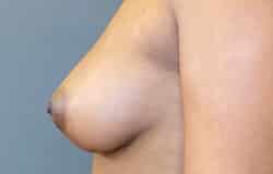 Breast Fat Grafting