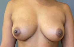 Breast Fat Grafting