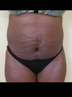 Tummy Tuck