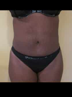 Tummy Tuck