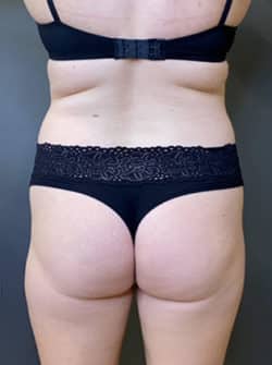 Brazilian Buttocks Lift (BBL)