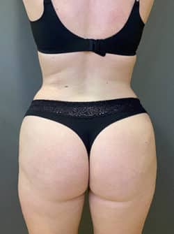 Brazilian Buttocks Lift (BBL)