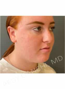 Chin Augmentation - Neck Liposuction