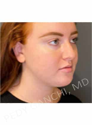 Chin Augmentation - Neck Liposuction