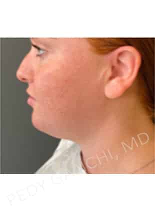 Chin Augmentation - Neck Liposuction