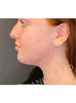 Chin Augmentation - Neck Liposuction