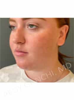 Chin Augmentation - Neck Liposuction