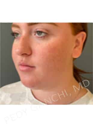 Chin Augmentation - Neck Liposuction