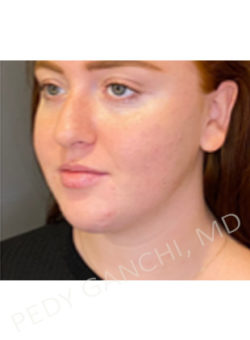 Chin Augmentation - Neck Liposuction