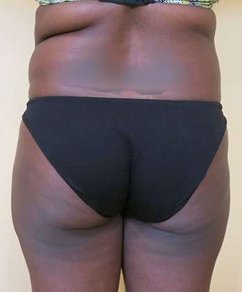 Brazilian Buttocks Lift (BBL)