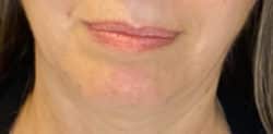 Mole/Lesion Removal