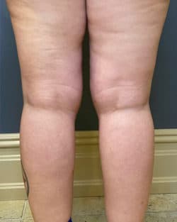 Liposuction