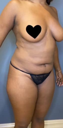 Liposuction