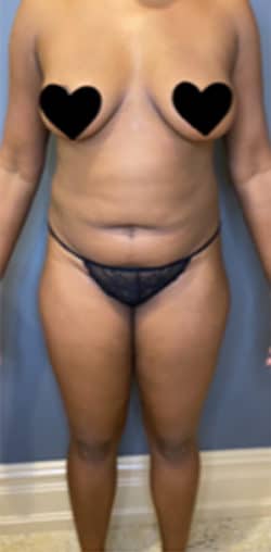 Liposuction