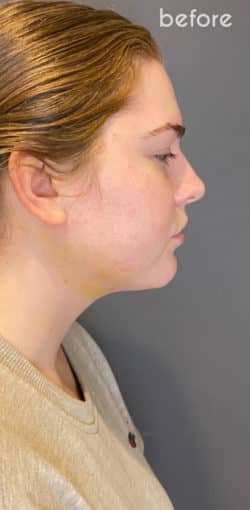 Chin Augmentation - Neck Liposuction