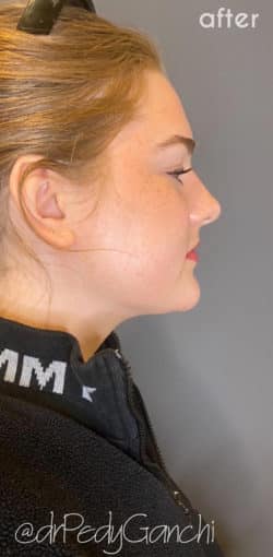 Chin Augmentation - Neck Liposuction