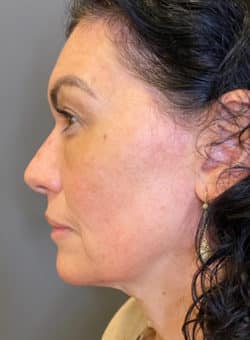 Face / Neck Lift