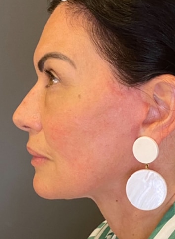 Face / Neck Lift