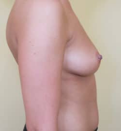 Breast Augmentation (Implants)