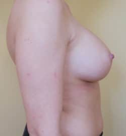 Breast Augmentation (Implants)