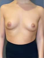 Breast Augmentation (Implants)