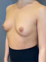 Breast Augmentation (Implants)