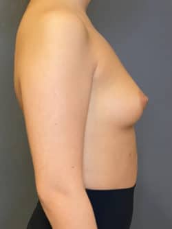 Breast Augmentation (Implants)