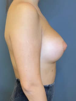 Breast Augmentation (Implants)