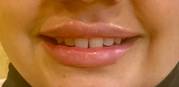 Fillers
