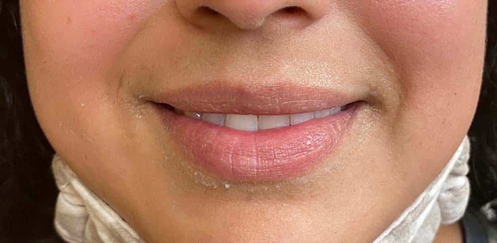 Lip Augmentation