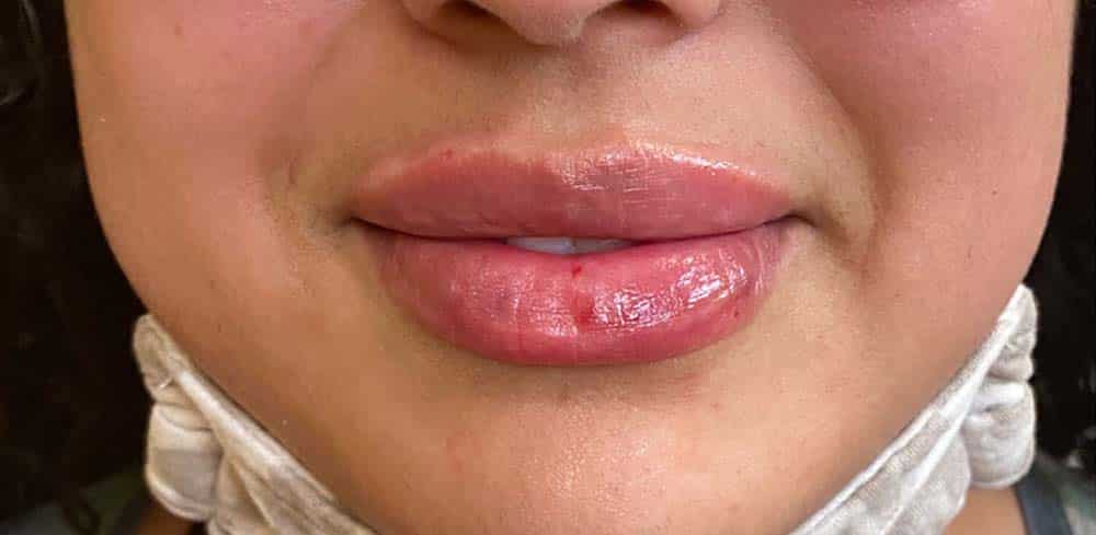 Lip Augmentation