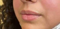 Lip Augmentation