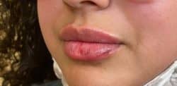 Lip Augmentation