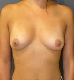 Breast Augmentation (Implants)