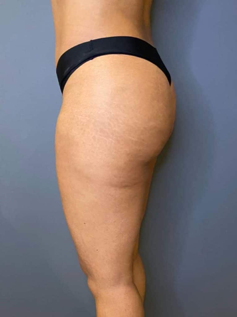 Liposuction