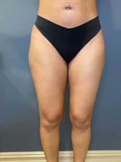 Liposuction