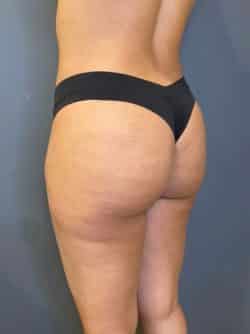 Liposuction