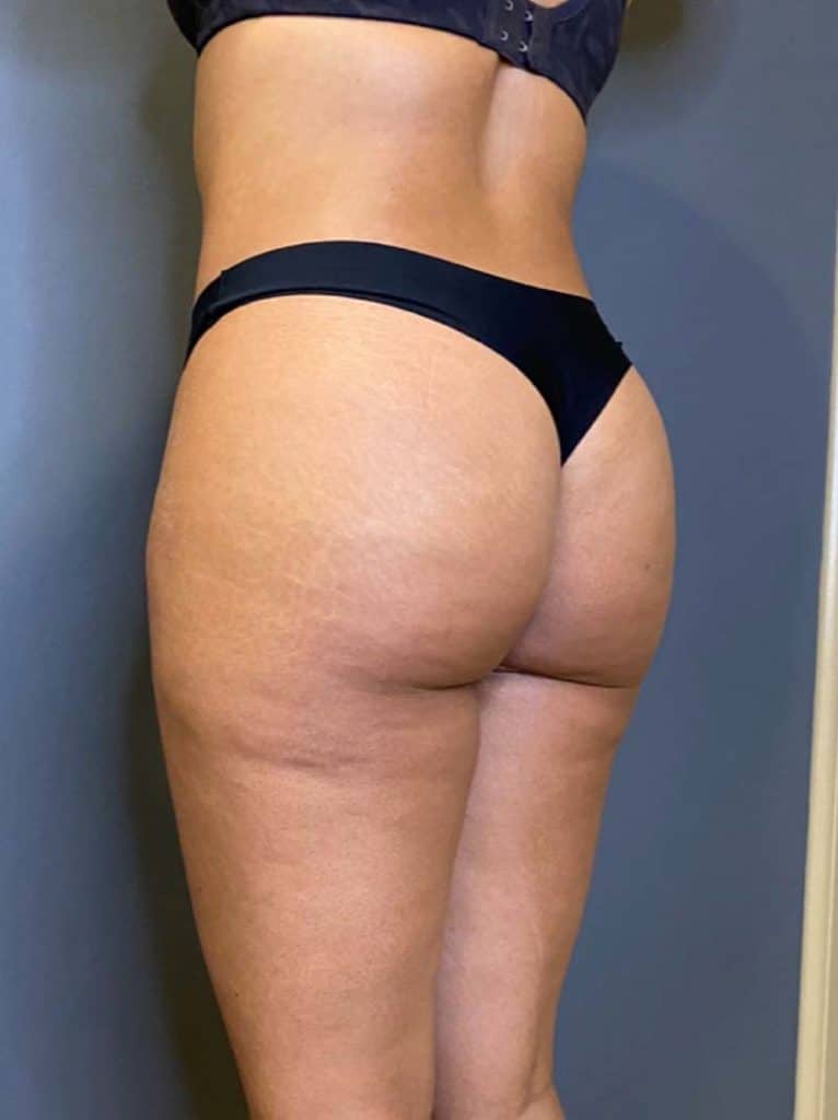 Liposuction