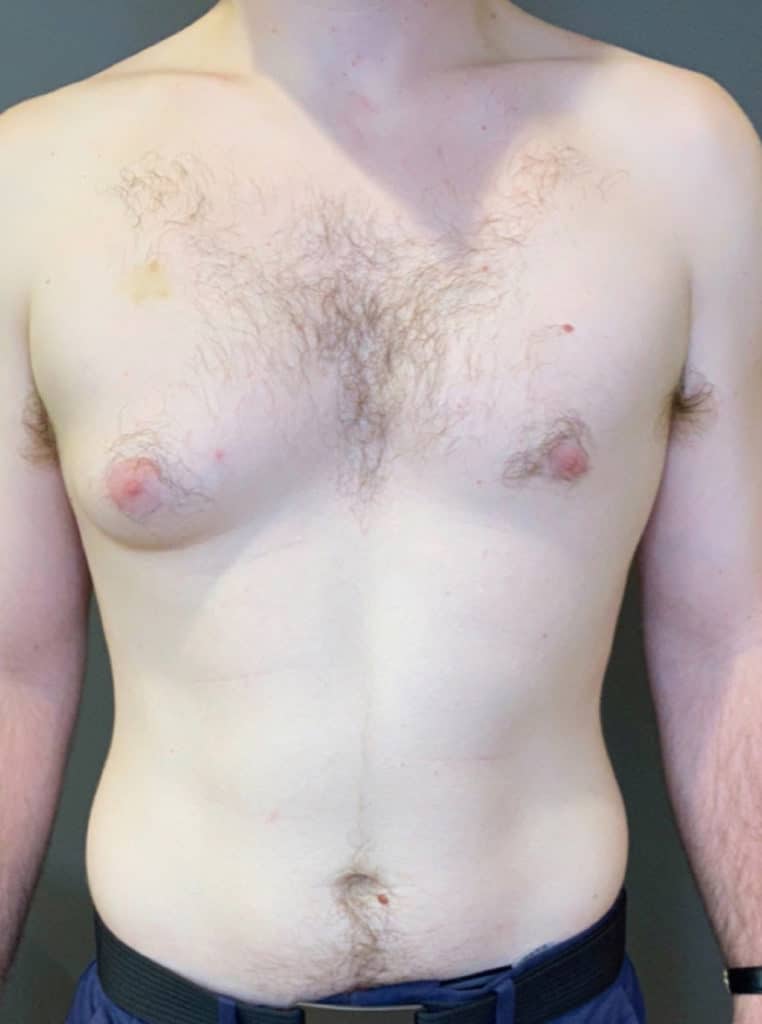 Gynecomastia (male breast reduction)