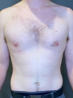 Gynecomastia (male breast reduction)