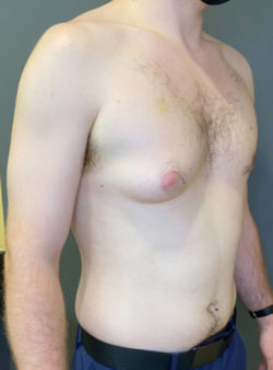 Gynecomastia (male breast reduction)